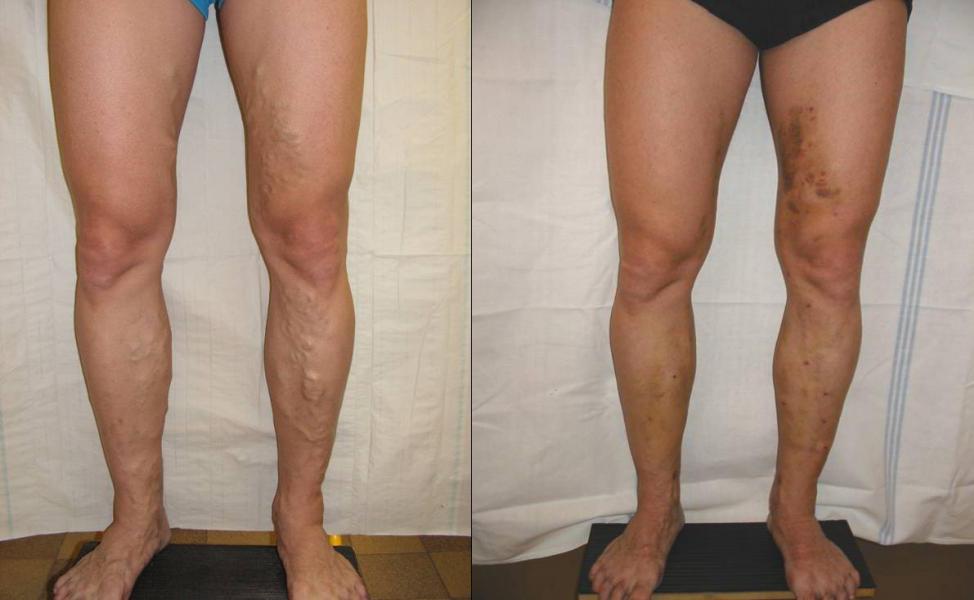 Gel per trattamento un varicosity