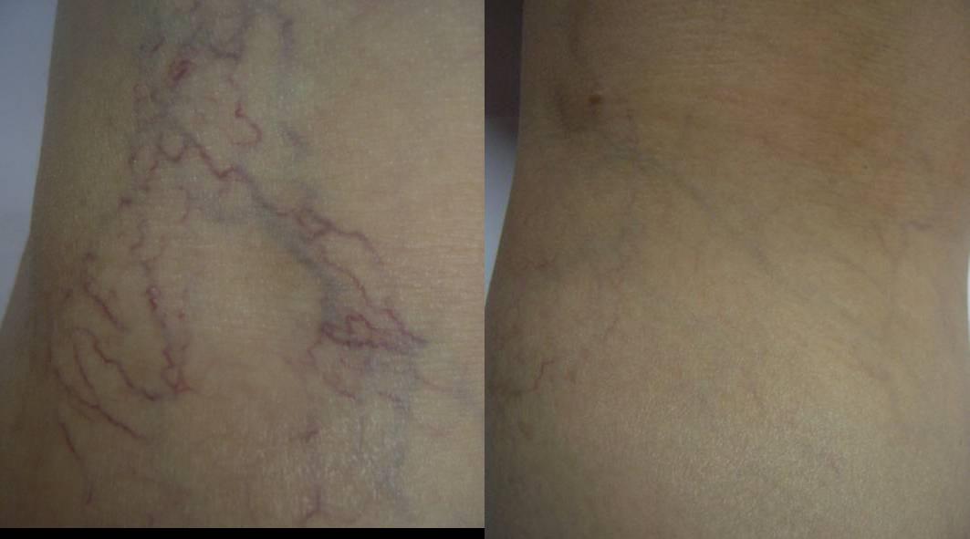 Colpo di trombosi arterioso