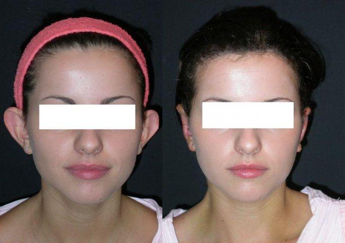 I petti di silicone emergono