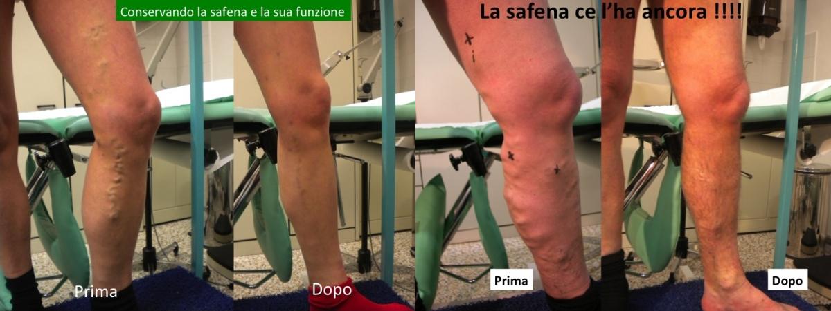 Sintomi di coagulo di sangue in una vena superficiale di una gamba