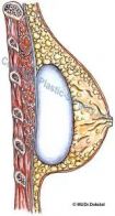 prsni implantat