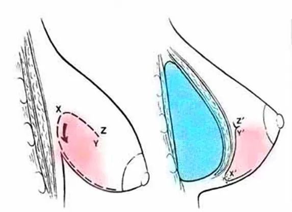 Seno tuberoso2