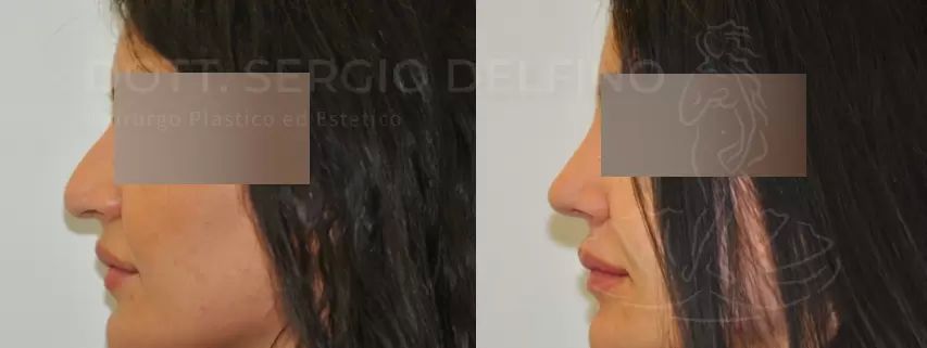 Rinoplastica - La correzione del naso con la gobba - foto prima e dopo