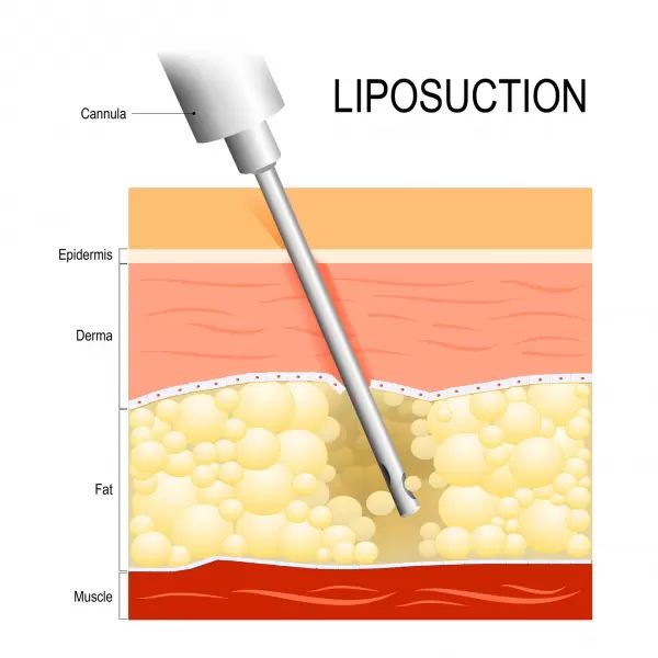 liposukce 2