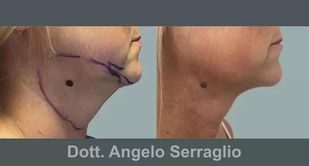 LipoLaser - Donna - Doppio mento Intervento di Liposuzione Laser in sedazione locale doppio mento