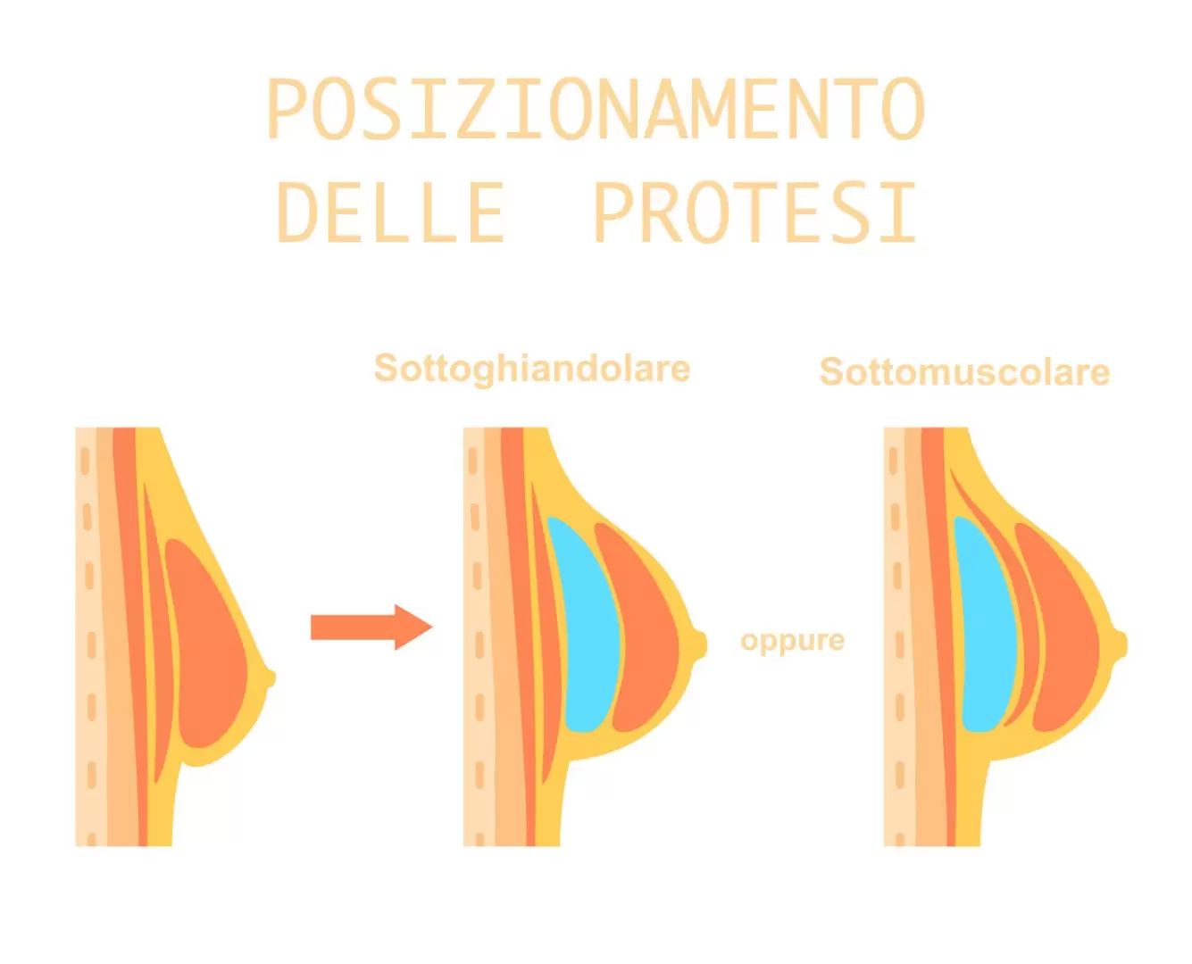 Posizionamento delle protesi