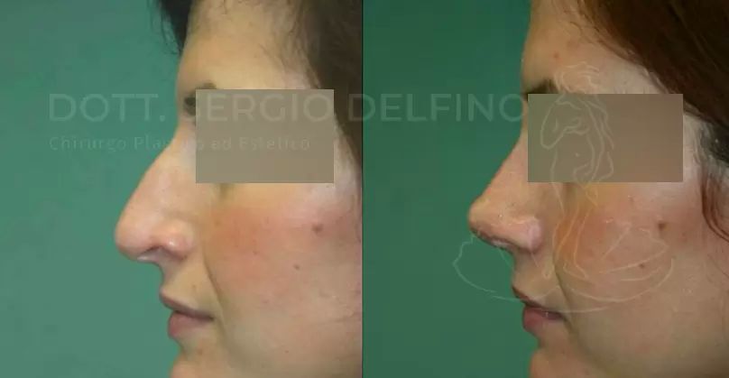 Intervento di rinoplastica sul naso gibboso - foto prima e dopo