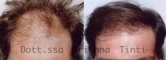 Trapianto di capelli foto prima e dopo
