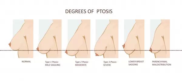 Grado di ptosi mammaria