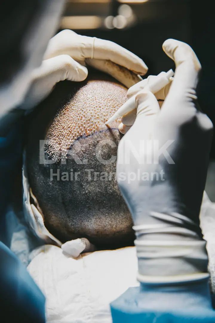 DHI Hair Transplant