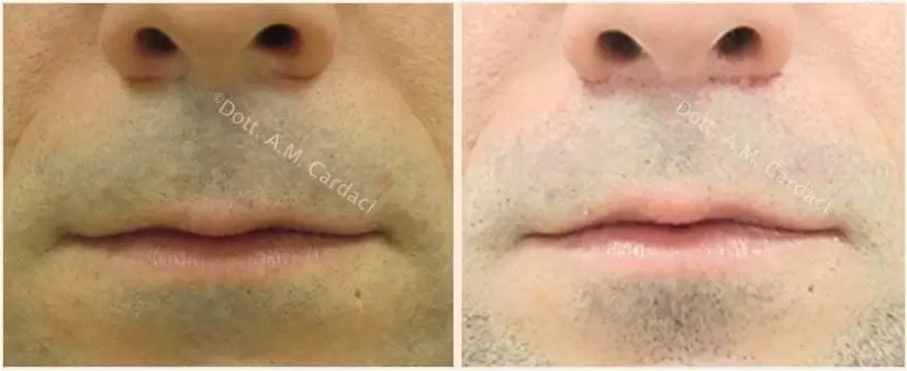 nasal lip lift prima e dopo