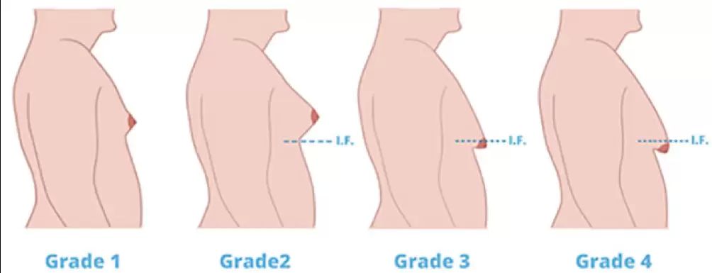 Diversi gradi di ginecomastia