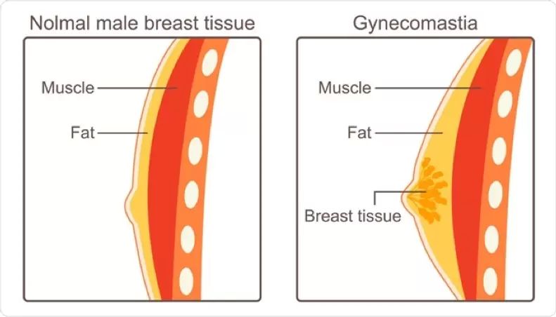 Sezione di mammella maschile normale e con ginecomastia
