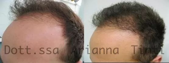 Trapianto di capelli prima e dopo